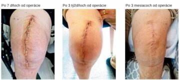 Recenzia na gél na jazvy Bliznasil od našej zákazníčky Rozálie