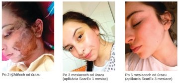 Reálne výsledky po používaní ScarEx gélu na jazvy