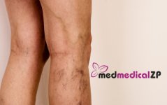 Kŕčové žily u mužov