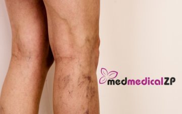 Kŕčové žily u mužov